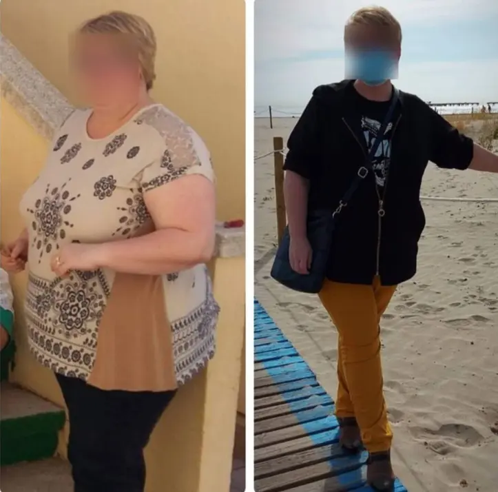 Pérdida de peso cirugía bariátrica castellón de la plana valencia